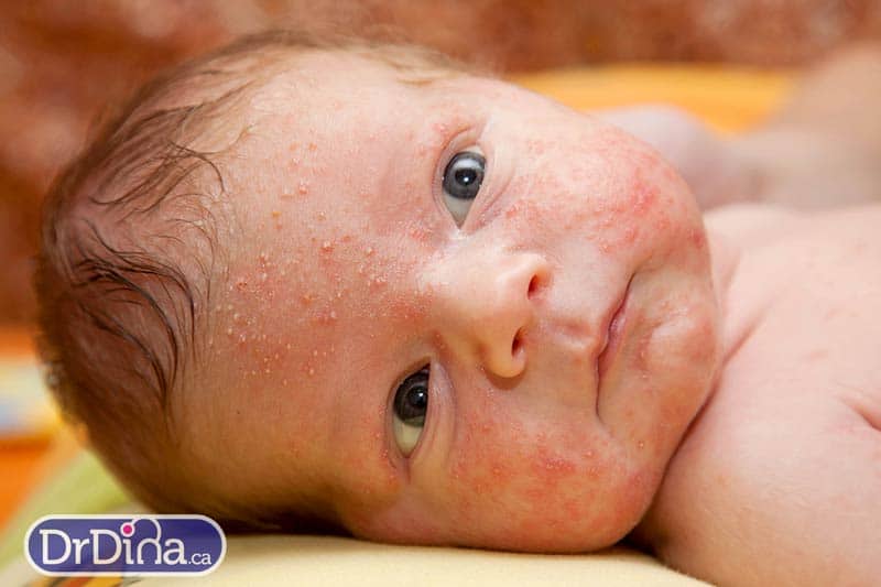 DrDina-Kids-Health-baby-acne-2