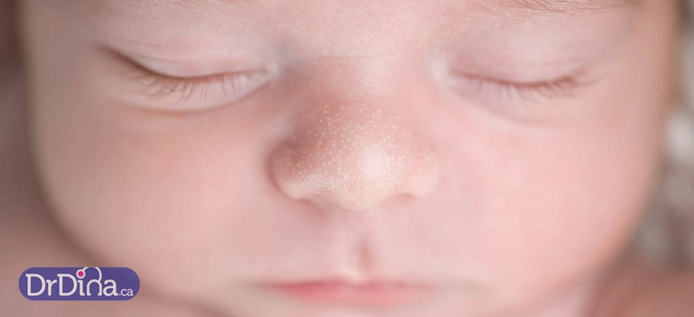 DrDina-Kids-Health-baby-acne-milia-1