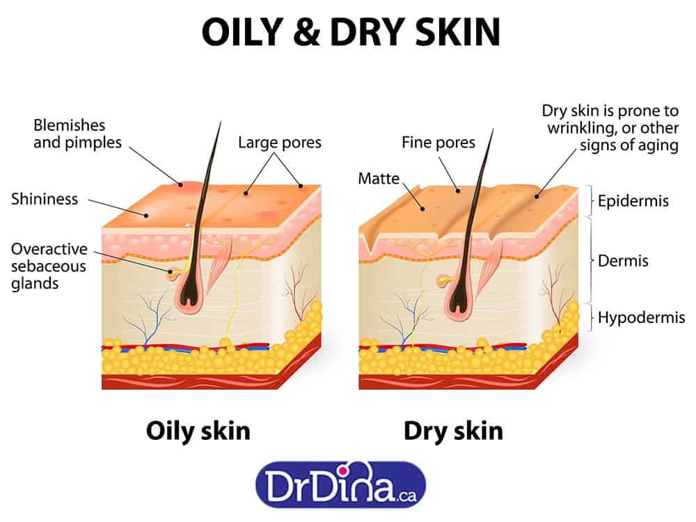 DrDina-Kids-Health-baby-acne-oily-dry-skin-1a